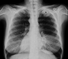 x-ray