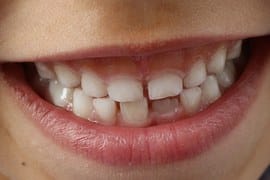 Benefits Of Using Dental Crown And Bridges