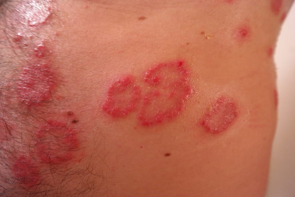 What Is Molluscum Contagiousum